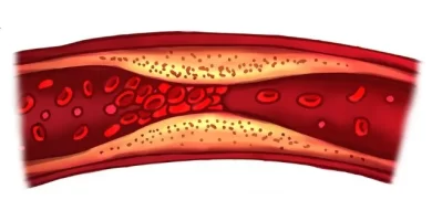 ¿Cómo limpiar las arterias de forma natural?