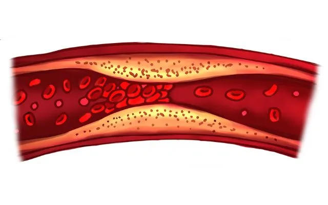 ¿Cómo limpiar las arterias de forma natural?